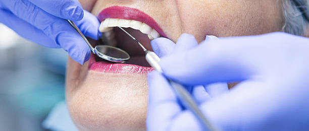 Best Knocked-Out Tooth (Avulsed Tooth) Treatment in Mayo, FL